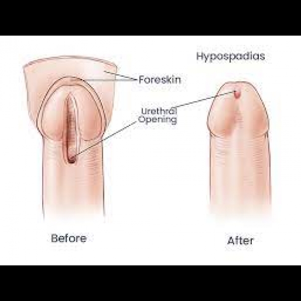 After Hypospadias Surgery