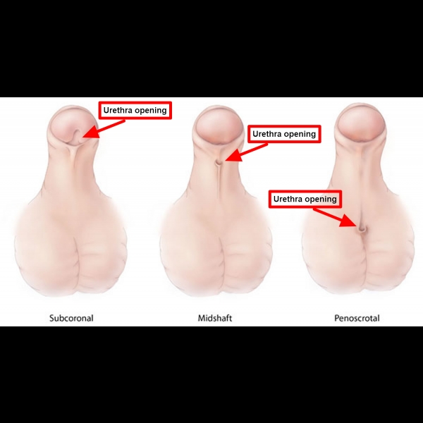 Type of Hypospadias
